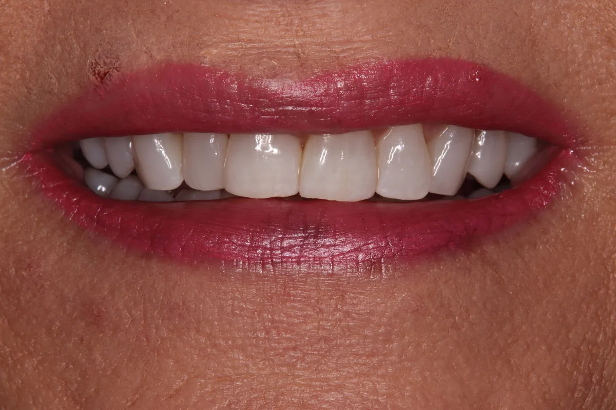 Lynette's smile transformation at Rod Gleave, DMD, before