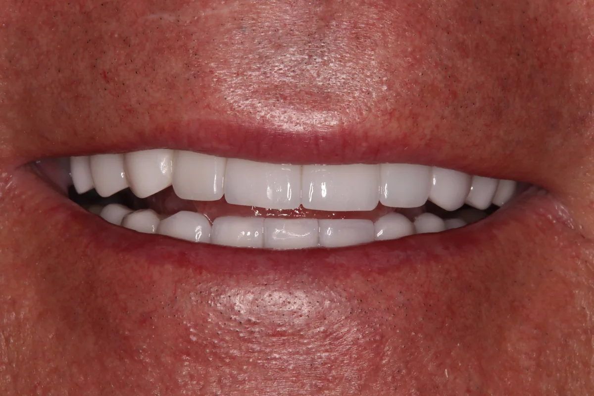 After (close-up), 18 Esthetic Crowns: Mark