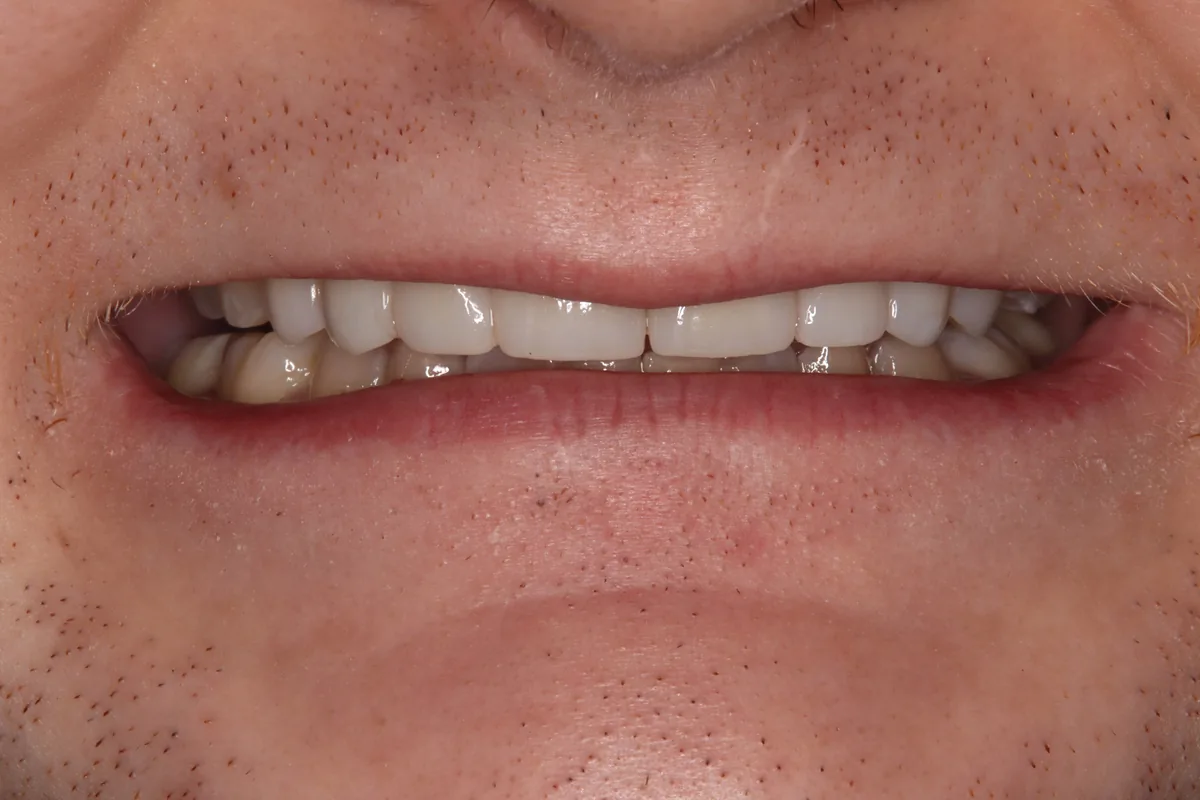 After (close-up), 8 Esthetic Crowns: Quate