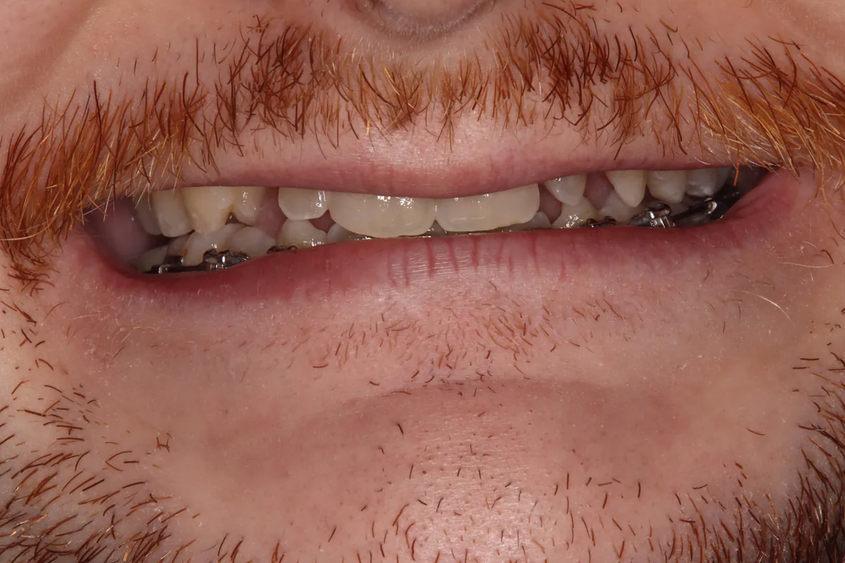 Before (close-up), 8 Esthetic Crowns: Quate