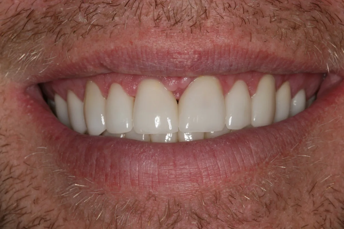 After (close-up), 14 Veneers + 2 All-Porcelain Crowns: Scott