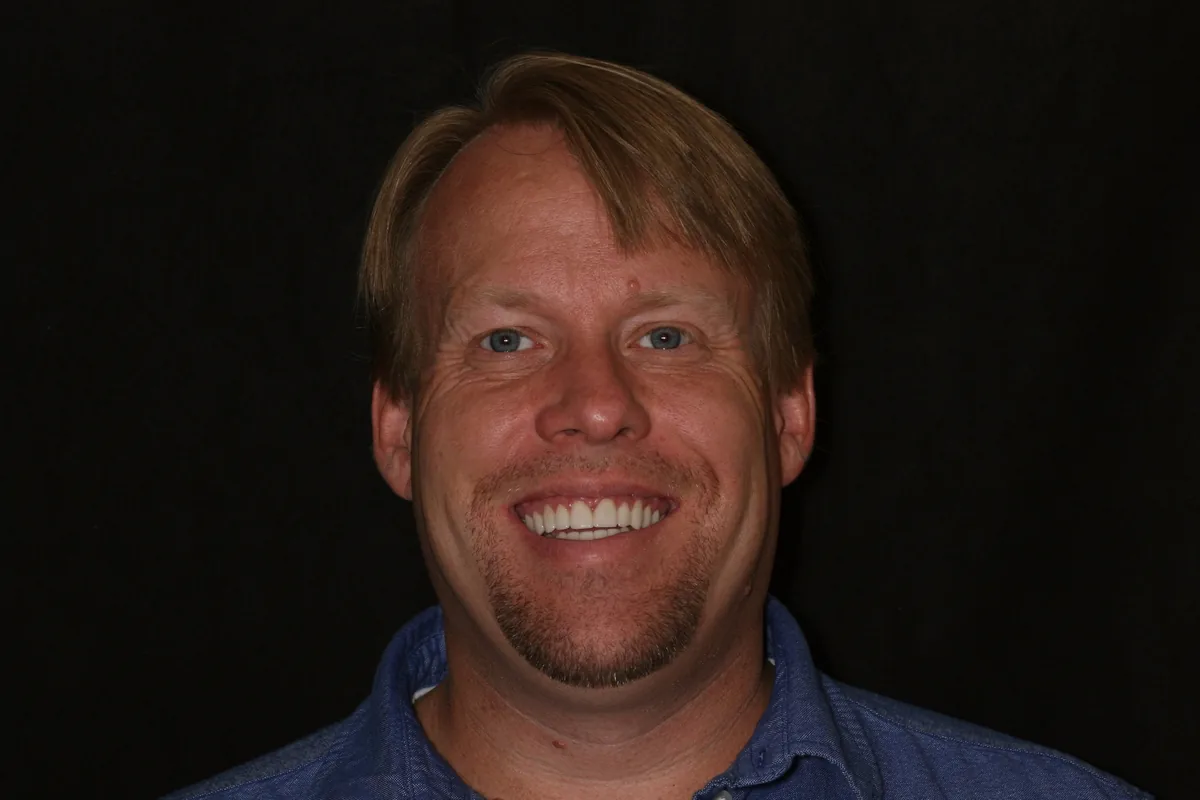 After, 14 Veneers + 2 All-Porcelain Crowns: Scott