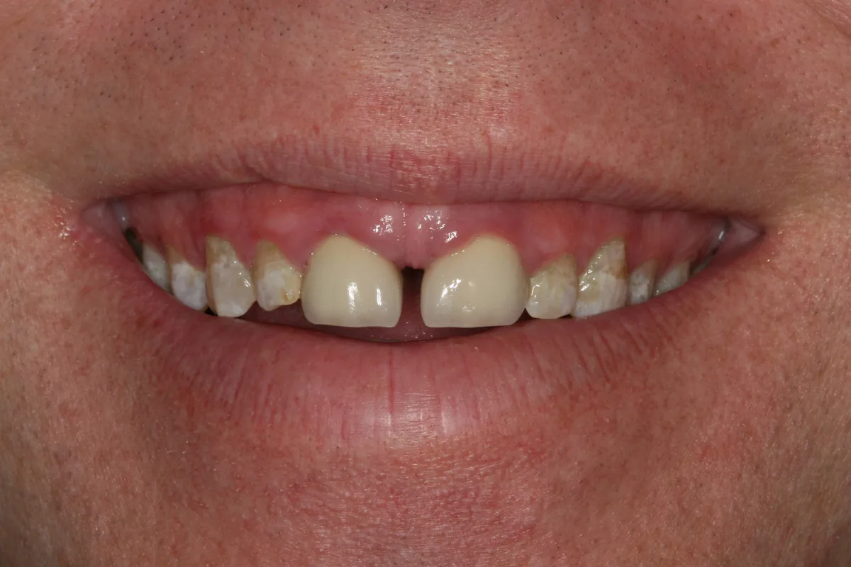 Before (close-up), 14 Veneers + 2 All-Porcelain Crowns: Scott