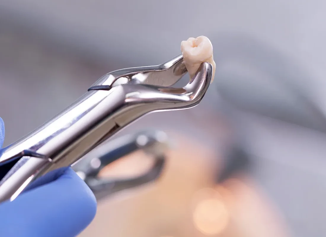 What is Wisdom Teeth Removal