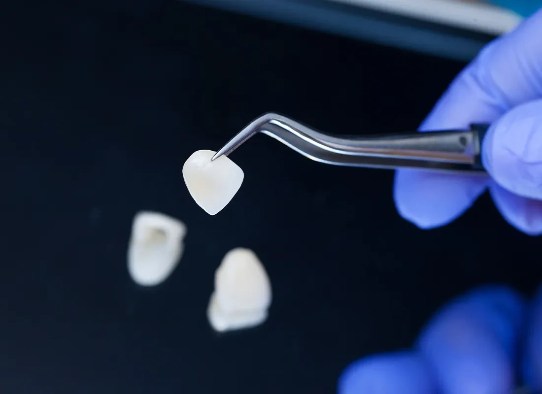 Porcelain Veneers at Rod Gleave, DMD